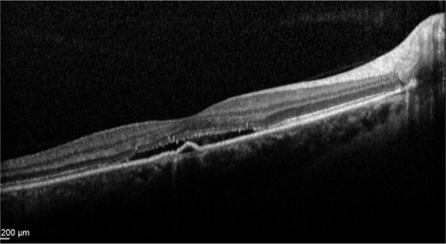 Figure 11 Acute central serous chorioretinopathy showing serous detachment with pigment epithelium detachment.