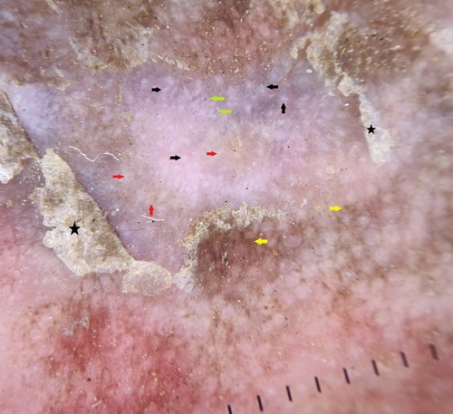 Figure 5 Dermoscopy of necrolytic acral erythema shows white (black arrows), yellow (red arrows) and brown (yellow arrows) globules. Red dots (green arrows) and dull white scales (black stars) are well appreciated.