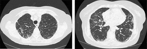 Figure 2. High-resolution computed tomography revealed interstitial changes with irregular reticulation (left) and basal traction bronchiectasis and subpleural consolidation (right).