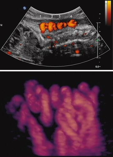 Figure 4 Sagittal image of breech-presenting fetus at 27 weeks’ gestation. Upper panel: Power Doppler image of quadruple nuchal cord. Lower panel: Power Doppler three-dimensional image of above. Note coiled nuchal cords. Reproduced with permission from Sherer DM, Dalloul M, Sabir S, London V, Haughton M, Abulafia O. Persistent quadruple nuchal cord throughout the third trimester associated with decelerating fetal growth. Ultrasound Obstet Gynecol. 2017;49(3):409–410. Copyright © 2016 ISUOG. Published by John Wiley & Sons Ltd.Citation87