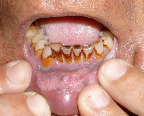 Figure 2 Dental staining and irregular cobble-stone pattern of oral mucosa.