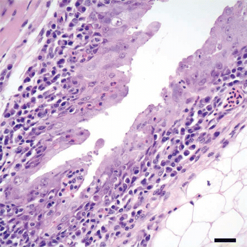 Figure 3.  Fornix of the conjunctiva from a cliff swallow with conjunctivitis. There is hyperplasia of conjunctival epithelium, evidenced by tufts and pilings of epithelial cells, and heterophils in low numbers are scattered in the hyperplastic epithelium. Note that the lamina propria is infiltrated by lymphocytes and plasma cells, and few cryptosporidial stages are present along the surfaces of epithelial cells. Bar = 20 µm. Haematoxylin and eosin.