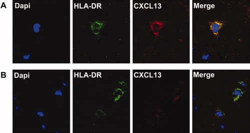 Figure 6. Immunohistochemistry of the umbilical cord vessel wall with (a) and without (b) funisitis. Nuclei of all cells are stained blue. Using HLA-DR labeling, macrophages are stained in green. Double-immunostaining with CXCL13 (in red) demonstrates CXCL13 within the cytoplasm of the macrophages. The localization of CXCL13 in the cytoplasm is apparent in the merged composite image.