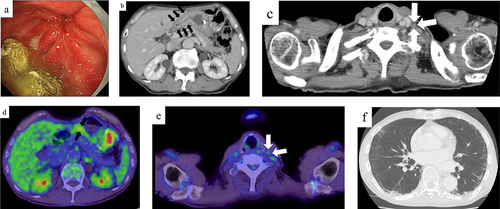 Figure 4 Endoscopic and radiological findings after pre-operative treatment. (a) On esophagogastroduodenoscopy after 3 courses of pre-operative treatment, an irregular ulcerative tumor had shrunk, mucosal irregularities had disappeared, and scarring was observed. (b and c) On contrast-enhanced computed tomography after 3 courses of pre-operative treatment, a thickening of the gastric wall (black arrows) and the size of swollen left supraclavicular lymph node (white arrows) were decreased. (d and e) On PET-CT after 3 courses of pre-operative treatment, a mild accumulation was still present in the stomach (SUVmax 3.33: black arrows) and there was no abnormal accumulation in a left supraclavicular lymph node (white arrows). (f) On plain chest computed tomography after 3 courses of pre-operative treatment, a mild ground glass opacity was detected.