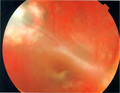 Figure 3 Postoperative view, showing a temporal exit with macular dragging.