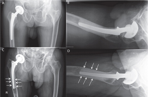 Figure 5. A 90-year-old man at 8 weeks (panels A and B) and 7 years (C and D) postoperatively. The images after 7 years (C and D) revealed osteolytic changes in the area of the SynPlug cement restrictor. Progressive radiolucencies first appeared distally around the prosthetic stem just proximal to the osteolytic changes in zone 4.