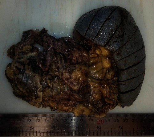 Figure 2 Gross examination shows already opened cystic mass of the pancreas.
