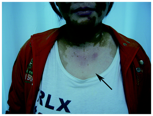 Figure 1. The patient that suffered from rash and pruritus and experienced vitiligo after 2 mo of PGIG treatment (shown by the arrow).