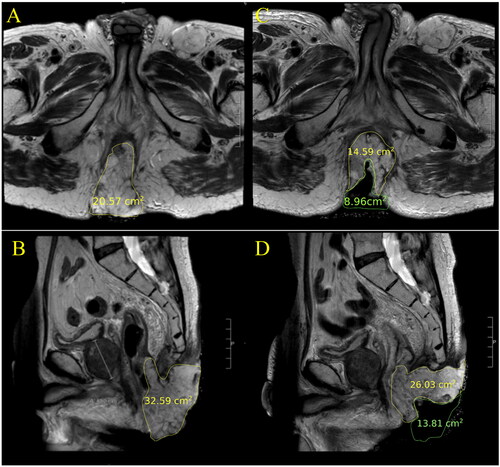 Figure 7. T2 weighted axial and sagittal MR images of patient 2. The images represent the maximum tumor extension in each orientation. Images A and B demonstrate pretreatment tumor volume. The tumor recurrence with large exophytic component shows a partial clinical response 3 months post treatment, as shown in images C and D.