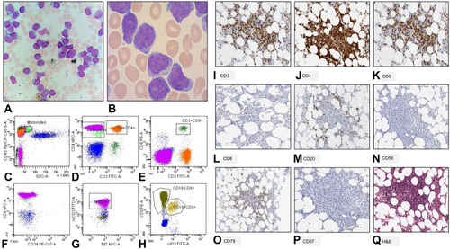 Figure 4 Case 3. Bone marrow (BM) aspirate showed a widespread lymphoid infiltration, predominantly small “mature” lymphocytes with very rare nucleoli (A and B). Examples of immunophenotypic features seen on peripheral blood samples of the reported case of concomitant T-PLL and MBL. Neoplastic T cells are in purple and express CD4 (D and lack CD8 (E) and CD34 (F). They lack surface CD3 expression, but present cytoplasmic CD3 (G). CD45 was expressed by only a subset of pathological T lymphocytes (C). B-CCL/SLL cells (in yellow) on the PB sample present typical co-expression of CD19 and CD5 (H). Trephine BM biopsy of the reported case of concomitant T-PLL and MBL displayed small and sometimes medium-size lymphoid elements (Q), original magnification ×20) with predominantly T phenotype: CD3+ (I), original magnification ×20), CD4+ (J), original magnification ×20), CD5+ (K), original magnification ×20), CD8- (L), original magnification ×20), CD20- (M), original magnification ×20), CD56- (N), original magnification ×20), CD79- (O), original magnification ×10) and CD57- ((P), original magnification ×20).