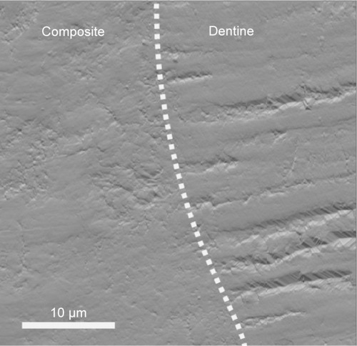 Figure 2 AFM image (deflection) of the interface between a dental composite and dentin.Notes: The dental composite appears very homogeneous, whereas the cross-sectional cut of dentin can be seen throughout the dentin part. The interface shows no apparent gaps. Compromised interface integrity, however, leads to nanoleakage that is always associated with pain, sensitivity, recurrent decay, and finally, failure of restorations.Abbreviation: AFM, atomic force microscopy.