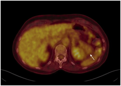 Figure 2. PET-CT shows a partly cystic partly solid tissue non-hypermetabolic mass located in the left hypochondrium, as indicated by the arrow.