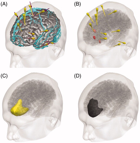 Figure 1. EpiNavTM 3D display of SEEG and resection planning. (A) Cortex model (grey) with overlying veins (cyan), SEEG planned trajectories (violet) and implemented electrodes (yellow). (B) Electrode contacts involved in seizure onset (red) and seizure propagation (pink). (C) Planned resection model incorporating areas of interest (yellow). (D) Completed resection following surgery (black) (see online version for colour figures).