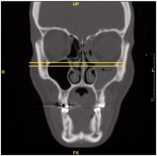 Figure 11. In the coronal section, opacification and atelectasis of the left maxillary sinus with collapse and downward bowing of the orbital floor can be seen.