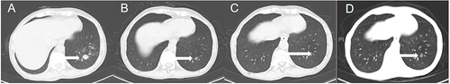 Figure 4 Chest CT images before and after treatment. The time of CT was (A) 2022-07-25, (B) 2022-09-14, (C) 2023-02-08, (D) 2023–06-28. (white arrow indicate lung mass).