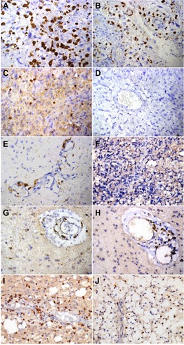 Figure 2 Synopsis of immunohistochemical markers of inflammatory infiltrate in astrocytomas. Glioblastomas: CD68 intratumoral and perivascular immunoreactivity (A and B), CD3-positive intratumoral infiltrate (C), and negative CD20 immunoreactivity (D). Anaplastic astrocytomas: CD68-positive perivascular infiltrate (E), and negative CD3 infiltrate (F). Diffuse astrocytomas: perivascular CD68 immunoreactivity (G), and CD3 perivascular infiltrate as exceptionally noted in a single case (H). Pilocytic astrocytomas: perivascular CD68 infiltrate (I), and intratumoral CD3 infiltrate (J), (immunoperoxidase, original magnification 400×).
