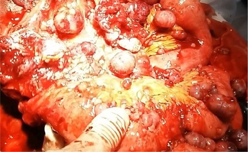 Figure 4 Masses in the mesentery of the small bowel.
