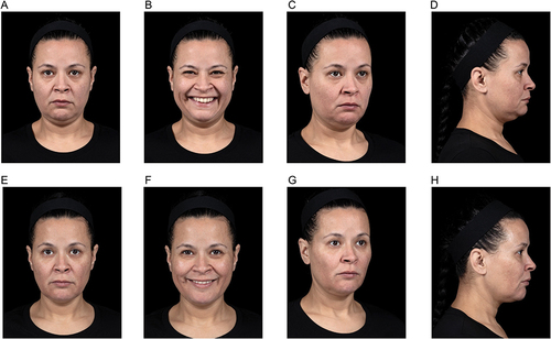 Figure 6 Full-face rejuvenation based on the MD Codes: a 42-year-old woman before (A–D) and immediately after (E–H) treatment. The woman presented with loss of definition in the cheekbone area, hollowing and dark circles under the eyes, and fullness and sagging in the lower face, with a double chin. Her primary concerns were bags around the eyes, double chin, and NLFs. The treatment plan for this patient was full-face rejuvenation with Juvéderm Voluma, Juvéderm Volift, and Juvéderm Volbella as described in Table 2 with no deviations and a total injected volume of 12 mL HA filler. After treatment, she was assessed as having a refreshed, less tired appearance and a more contoured and slimmer-looking face with more caring and optimistic social attributes. HA, hyaluronic acid; NLFs, nasolabial folds.