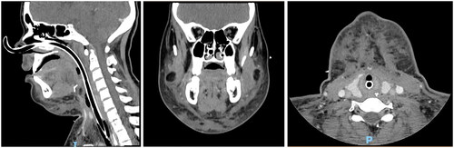 Figure 3. CT scan four weeks postop.