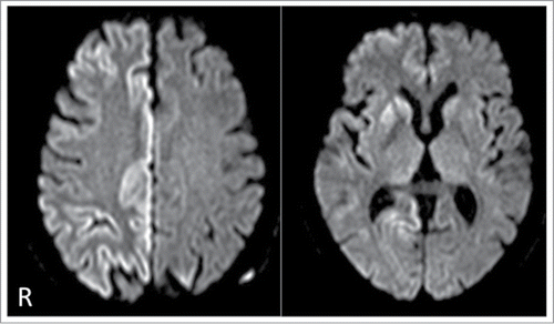 Figure 1. Diffusion-weighted magnetic resonance images showing increased signal intensity in the right basal ganglia and the right frontal, parietal, and occipital cortices.