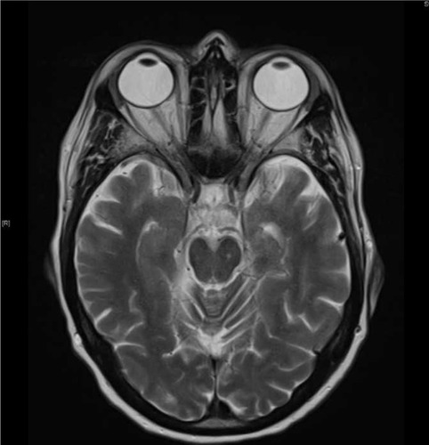 Figure 2 Current admission shows less pronounced left mesial temporal abnormality.