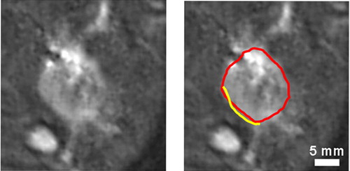 Figure 4. Comparison of the cell-death boundary with the outer boundary of the hyperintense region in the MR image. Post-ablation T2-weighted MR images at left and right are identical except for graphical overlays on the right-hand image showing the cell-death boundary (in yellow) and the outer boundary of the hyperintense region (in red). The MR boundary is manually marked with a graphical overlay. The cell-death boundary is marked on the registered histology image with a graphical overlay and copied to the MR image. The white regions in the MR images are strips of fat and the elliptical femur bone in the lower left corner. The figure is reproduced in colour in the online issue of Computer Aided Surgery.