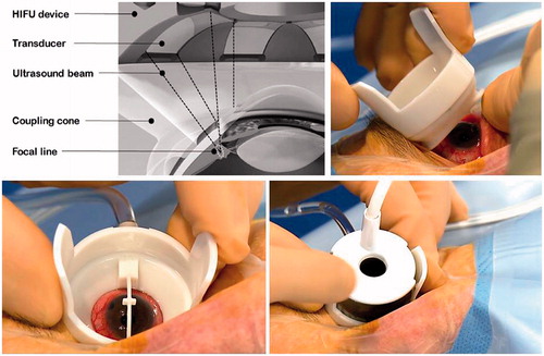 Figure 3. Schematic cross-section of the HIFU device to treat glaucoma (top left) and pictures of the device on a human eye (top right and bottom).