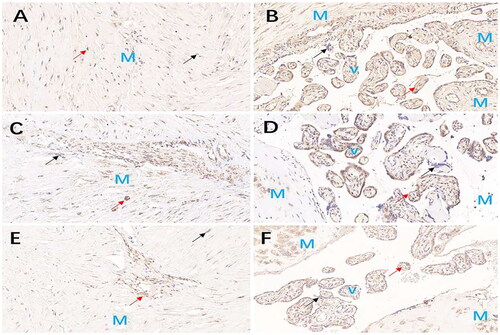 Figure 1. IGF-1, bFGF, and PLGF placental bed tissue expression at 400x magnification in complete placenta previa patients without PAS disorders (control group) and with PAS disorders (case group). (A) IGF-1 expression in placental bed tissues of patients without PAS disorders (CPP). (B) IGF-1 expression in placental bed tissues of patients with PAS disorders. (C) bFGF expression in placental bed tissues of patients without PAS disorders. (D) bFGF expression in placental bed tissues of patients with PAS disorders. (E) PLGF expression in placental bed tissues of patients without PAS disorders. (F) PLGF expression in placental bed tissues of patients with PAS disorders. (M) represents the myometrium. (V) represents the villous trophoblastic cells. (Black arrows) indicate the blue-colored granules, representing the staining intensity of the nucleus. (Red arrows) indicate the brown-yellow granules, representing the positive cells.