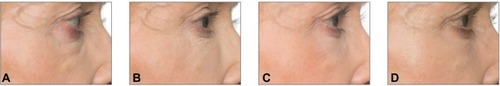 Figure 4 A 61-year-old female patient with a Merz Aesthetics Scale® score 3 for infraorbital hollow at baseline (A) received supraperiosteal injections of 0.6 mL CPM® hyaluronic acid gel per side. (B) 3 months, (C) 6 months, and (D) 9 months after treatment.® Dr. Huber-Vorländer.