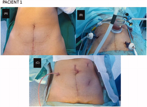 Figure 3. Closed-abdomen laparoscopic HIPEC by CO2 recirculation. Patient 1. A: before surgery; B: during laparoscopic HIPEC; C: after surgery.
