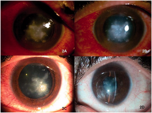 FIGURE 2. Clinical photographs showing gradual resolution of corneal infection after (A) 4 days, (B) 9 days, (C) 1 month, and (D) 3 months after treatment in a case with post-collagen cross-linking keratitis.