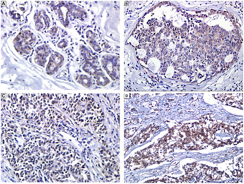 Figure 1 Immunohistochemical expression of YAP1 in breast cancer. (A) Normal breast acini showing expression of YAP1 in myoepithelial cells and cytoplasmic expression in luminal cells (Immunoperoxidase, x400). (B) Ductal carcinoma in-situ (DCIS) showing cytoplasmic expression of YAP1 in ductal epithelial cells (Immunoperoxidase, x200). (C and D) Invasive ductal carcinoma, NST (luminal type) showing cytoplasmic and nuclear expression of YAP1 in tumor cells (Immunoperoxidase, x200).