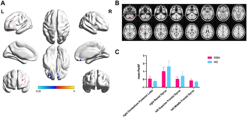 Figure 2 Comparison of the PerAF signal in patients OSA and HCs. (A and B) The different brain regions were observed in the right rectal gyrus, left superior frontal gyrus, right cerebellum posterior lobe and left middle frontal gyrus in the OSA group. The red areas denote higher PerAF brain regions, and the blue areas denote lower PerAF brain regions. (C) The mean PerAF values in the 2 groups.