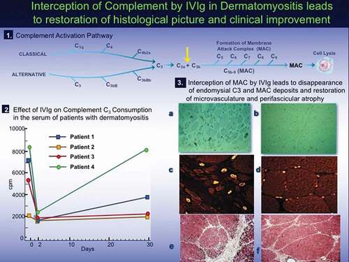 Figure 2. Interception of complement by IVIg in Dermatomyositis leads to restoration of histological picture and clinical improvement [modified from [Citation23,Citation24]].