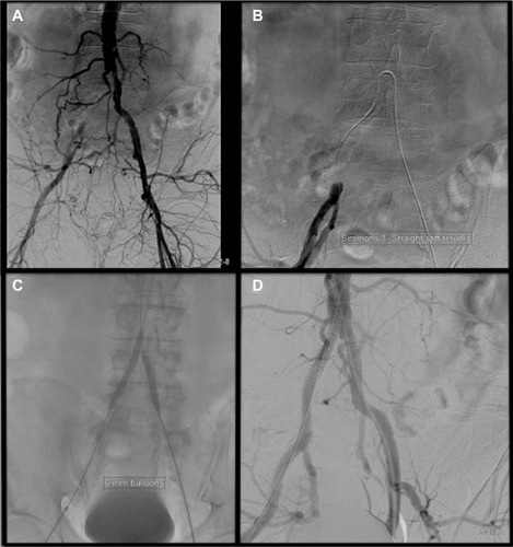Figure 1 Balloon-expandable stent placement for treatment of bilateral common iliac artery disease.