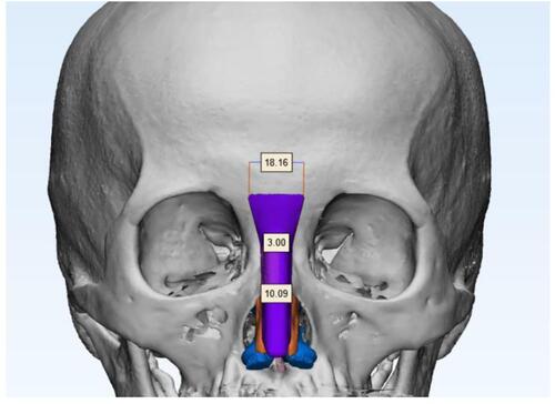 Figure 3 3D-designed nasal implant.