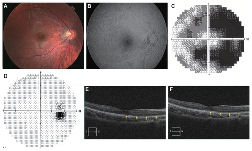 Figure 1 Fundus photograph, fluorescein angiographic image, Humphrey static perimetry, and Optical coherence tomography (OCT) of the right eye. (a) Fundus photograph at the onset showing that the retina was normal. (b) Fluorescein angiography at the onset showing normal vascular pattern and no leakage. (c) Humphrey static perimetry at the onset showing enlarged blind spot (30-2 strategy MD −21.97 dB). (d) Humphrey static perimetry 3 months after the onset showing marginally enlarged blind spot (30-2 strategy MD −1.90 dB). (e) OCT image at the onset showing irregular inner segment/outer segment (IS/OS) line over the nasal fovea. (f) OCT image 5 months after the onset showing reappearance of IS/OS line over the nasal fovea.