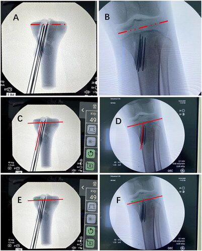 Figure 2. The angle and distance difference between the preoperative 3D model (planned insertion trajectories) and the actual operation (real insertion trajectories). The size of the 3D model (A) and actual bone (B) was corrected by scale. The angle was measured between the steel needle and epiphyseal line in the preoperative 3D model (C) and in the actual bone (D). The distance from the intersection of the steel needle and the epiphyseal line to the edge of the epiphyseal line (Green line) was recorded in the 3D model (E) and in actual bone (F).