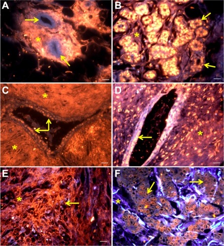 Figure 2 Mammary tissues stained by QD-Con A: normal breast (A), fibroadenoma (C), and invasive ductal carcinoma (E). Mammary tissues labeled with QD-UEA I: normal breast (B), fibroadenoma (D), and invasive ductal carcinoma (F).Notes: Scale bar 20 μm. Tissue autofluorescence is shown in blue. QD-Con A and QD-UEA I labeling is shown in red-orange. Yellow arrows indicate ductal cells whereas asterisks indicate stromal areas. Excitation by ultraviolet light.Abbreviations: QD-Con A, quantum dot-concanavalin A conjugate; QD-UEA I, quantum dot-Ulex europaeus agglutinin I conjugate.