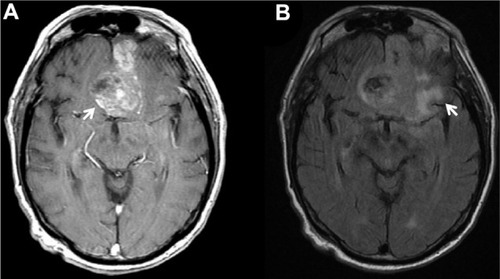 Figure 3 (A) Axial MR T1 with contrast demonstrates heterogeneously enhancing lesion along midline and left frontal area (arrow). (B) Axial MR FLAIR demonstrates perilesional edema (arrow).