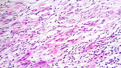 Figure 1 ITCs at advancing front of tumour in poorly differentiated OSCC of tongue; pN1 status (H+E stain; ×100).