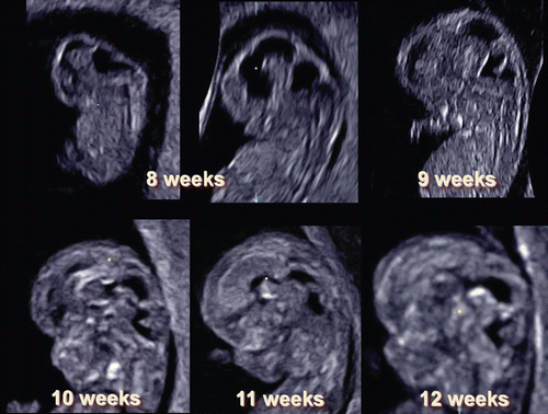 Figure 16.  Normal brain development by mid-sagittal 3D US section between 8 and 12 weeks of gestation).