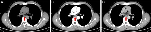 Figure 2 The initial thoracic CT indicated that the middle thickening esophageal wall was markedly enhanced. Plain scan (A); arterial phase (B); venous phase (C).