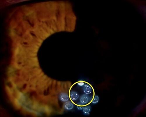 Figure 3 Slit lamp image of initial conductive keratoplasty (CK) spot placement at ~3.5 optical zone (enclosed within yellow circle). These three spots were placed based on the Pentacam scan and ring reflections as described in the text. After a repeat Pentacam scan, the anterior postoperative image showed more astigmatic regularity but not the desired overcorrection. Additional spots (seen outside the yellow circle) were placed near the initial CK spots to achieve the desired overcorrection.