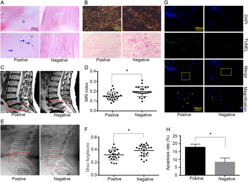 Fig. 1 IVDs positive for P. acnes had more apoptotic NPCs concomitant with severe disc degeneration in patientsa H&E staining revealed rod-shaped bacteria growing in clusters in human disc tissues (indicated by blue arrows). b The severity of degeneration in the annulus fibrosus and nucleus pulposus was evaluated by Picrosirius Red and Safranin-O staining, respectively. c–f Representative images from MRI (c) and lateral X-ray (e) indicated severe degeneration in P. acnes-positive IVDs (n = 23 for each group). g, h More apoptotic NPCs were found in P. acnes-positive IVDs by TUNEL staining (n = 9 for each group). *P < 0.05, P values were analyzed using Student’s t test