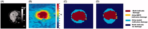 Figure 2. Representative thermometry data and calibrated model damage predictions. (A) The magnitude of the complex valued thermometry data provides a visualisation of the anatomy and is provided as a reference. The applicator trajectory is observed as a signal void in the image. The ROI displayed has a 3.75 × 3.28 cm2 field of view and is shown in B–D. (B) MR thermometry at maximum heating is shown. (C) finite element method (FEM) model-predicted Arrhenius damage is compared to Arrhenius damage based on MRTI. (D) A comparison of the steady-state damage model is shown. The steady-state damage model is the region enclosed by the 57 °C isotherm. The colour map indicates the geometrical overlap used in DSC calculations; the legend is at right (C). Respective DSC values for the FEM model (C) and steady-state model (D) are DSC = 0.8385 and DSC = 0.7442.