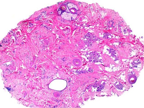 Figure 7 Histology of traction alopecia. On horizontal sections at the level of the low follicular level, there is altered follicular architecture due to areas of follicular drop out. There are only four follicles (hematoxylin and eosin, ×2).