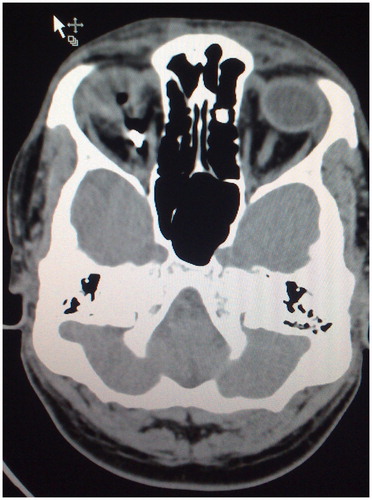 Figure 2. An axial cut section of a CT scan image of the right orbit shows a metallic foreign body embedded in the medial intraconal space, lying posterior to the globe and adjacent to the optic nerve.