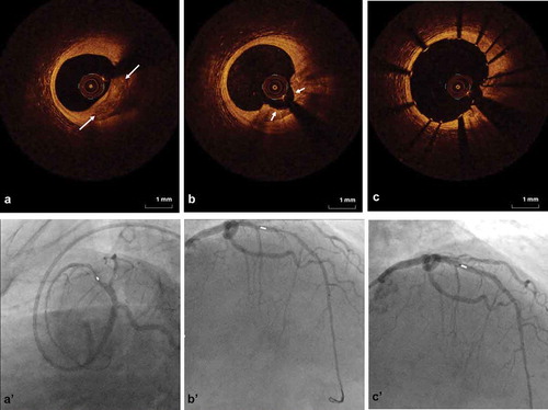 Figure 3. OCT imaging with angiographic co-registration of coronary OAS treatment. Top row is OCT imaging; bottom row is angiographic co-registration. a and a’. Baseline image of calcified coronary lesion (white arrows) pre-OAS treatment. b and b’. Post-OAS image indicating calcified plaque modification (short white arrows). c and c’. Final image showing stent expansion and apposition.