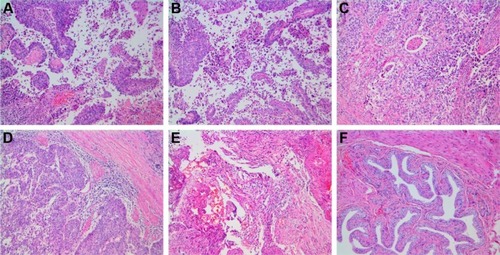 Figure 7 Histopathology.Notes: (A) Control; (B) LK; (C) PTX; (D) LK/P; (E) PTX/P; (F) LK/PTX/P. Disorganized cells, pathological mitotic figure, and papillary hyperplasia are observed in local or multiple regions in the Control group; the cell abnormality in LK and PTX groups is lower than that of the Control group; the cell abnormality in the LK/P and PTX/P groups is lower than that of the LK and PTX groups; and the cell abnormality in the LK/PTX/P group is significantly lower than that of the LK/P and PTX/P groups. Hematoxylin-Eosin staining, magnification ×100.Abbreviations: LK, lumbrokinase; P, PEG-b-(PELG-g-(PZLL-r-PLL)); PEG-b-(PELG-g-(PZLL-r-PLL)), poly(ethylene glycol)-b-(poly(ethylenediamine l-glutamate)-g-poly(ε-benzyoxycarbonyl-l-lysine)-r-poly(l-lysine)); PTX, paclitaxel.